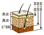 やけど状態解説イラスト